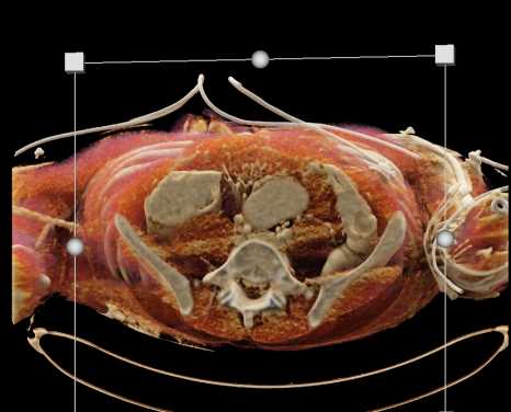 Dilated Colon - CTisus CT Scan