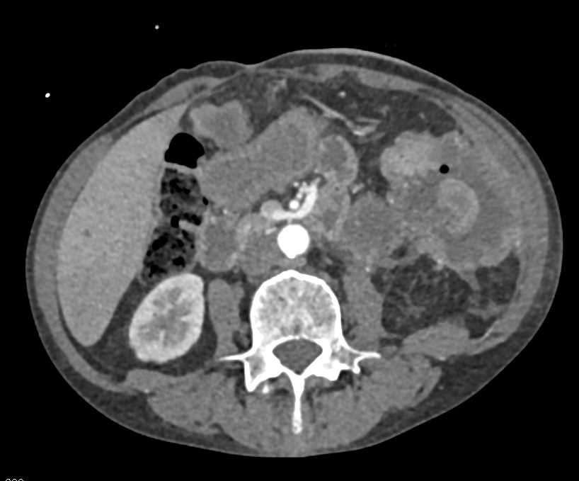 Colon Cancer Splenic Flexure with Liver Metastases - CTisus CT Scan