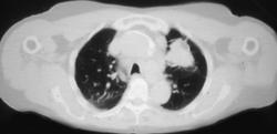 Lung Cancer With Mediastinal Nodes - CTisus CT Scan