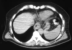 Esophageal Cancer With Pre-aortic Nodes - CTisus CT Scan