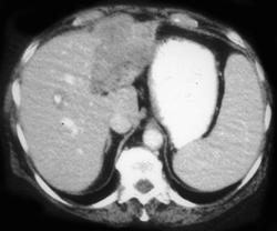 Liver Metastases - CTisus CT Scan