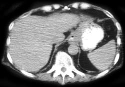 Esophageal Cancer - CTisus CT Scan