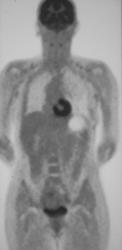 Hepatic Hemangioma - CTisus CT Scan