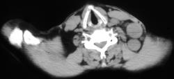 Lymphoma - CTisus CT Scan