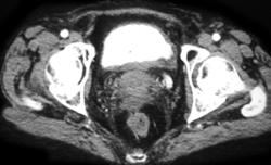 Bladder Cancer - CTisus CT Scan