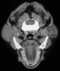 Sjogren's Syndrome (enlarged Right Parotid Gland) - CTisus CT Scan