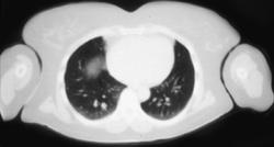 Lung Metastases - CTisus CT Scan