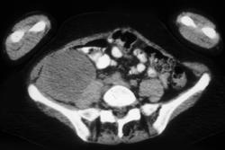 Recurrent Ovarian Cancer - CTisus CT Scan