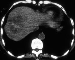 Liver Metastases- Colon Cancer - CTisus CT Scan