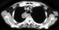 Lung Cancer - CTisus CT Scan