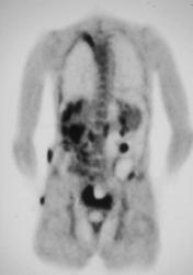 Ovarian Carcinomatosis - CTisus CT Scan