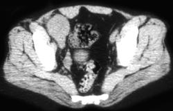 Melanoma (RLQ) - CTisus CT Scan