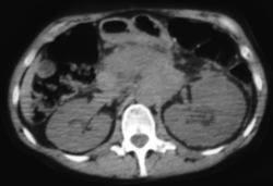 Recurrent Pancreatic Cancer - CTisus CT Scan