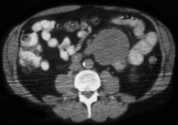 GIST Tumor - CTisus CT Scan