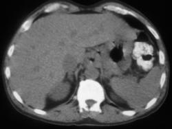 Gastric Cancer - CTisus CT Scan