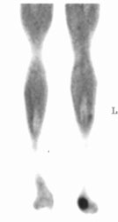 Sarcoma of the Great Toe - CTisus CT Scan