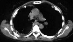 Mesothelioma - CTisus CT Scan