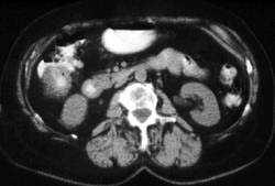 Cecal Cancer - CTisus CT Scan