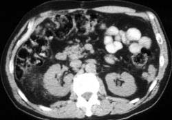 Carcinomatosis - CTisus CT Scan