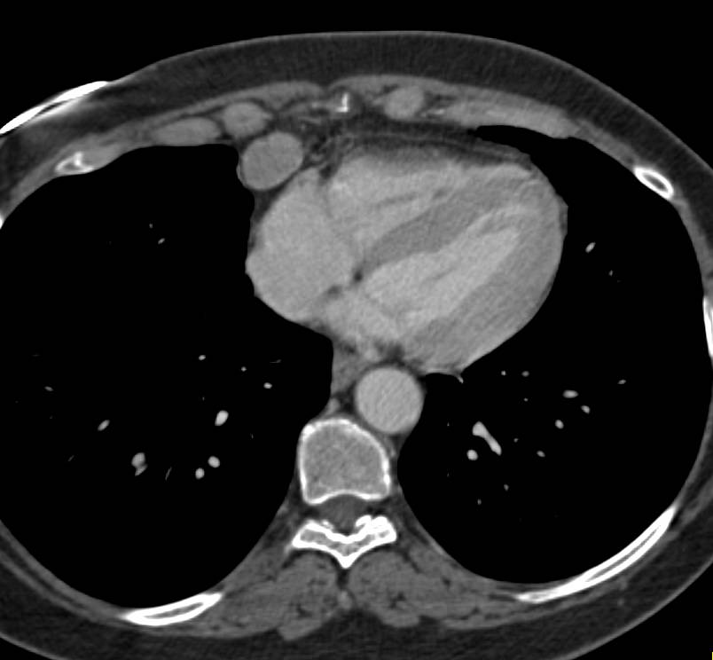 Enlarged Right Paracardiac Nodes - CTisus CT Scan
