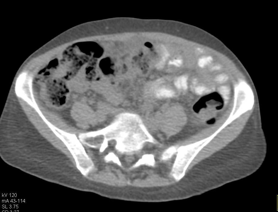 Colon Cancer with Carcinomatosis - CTisus CT Scan