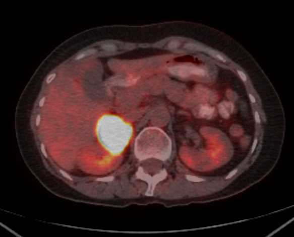 Metastases to the Left Adrenal Gland - CTisus CT Scan