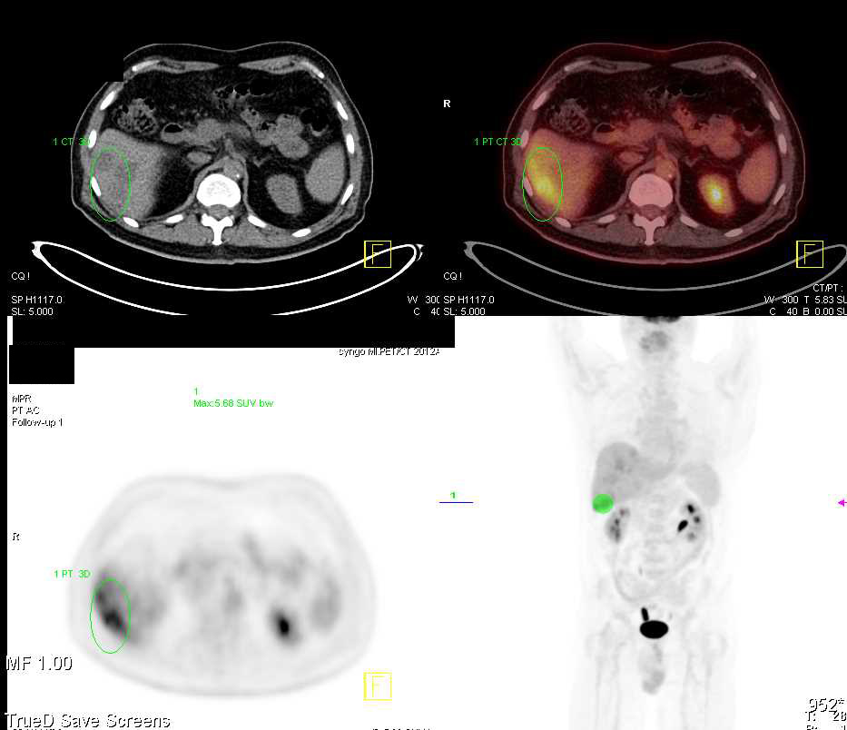 Multiple Liver Metastases - CTisus CT Scan