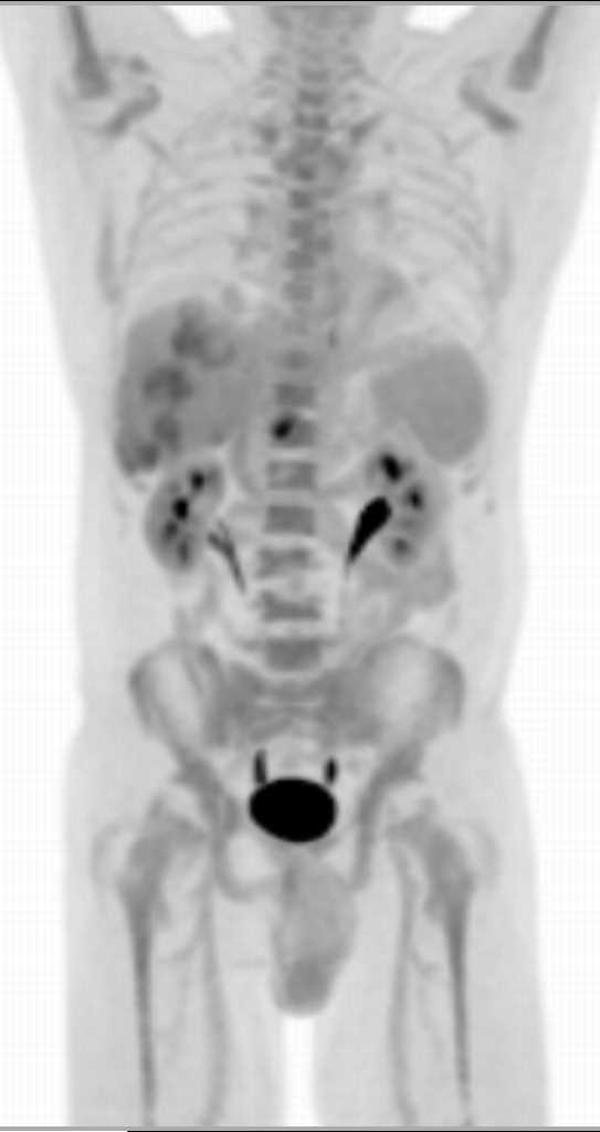 Multiple Liver Metastases from Colon Cancer - CTisus CT Scan