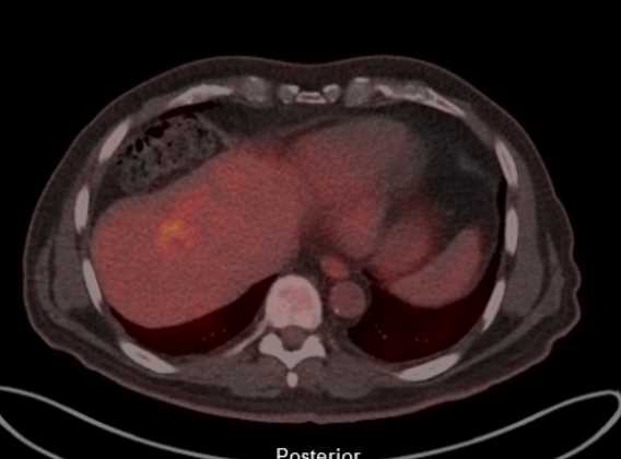 Colon Cancer with Liver Metastases - CTisus CT Scan