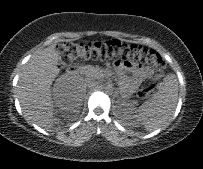 Recurrent Renal Cell Carcinoma with  Right Adrenal Metastases on PET CT - CTisus CT Scan