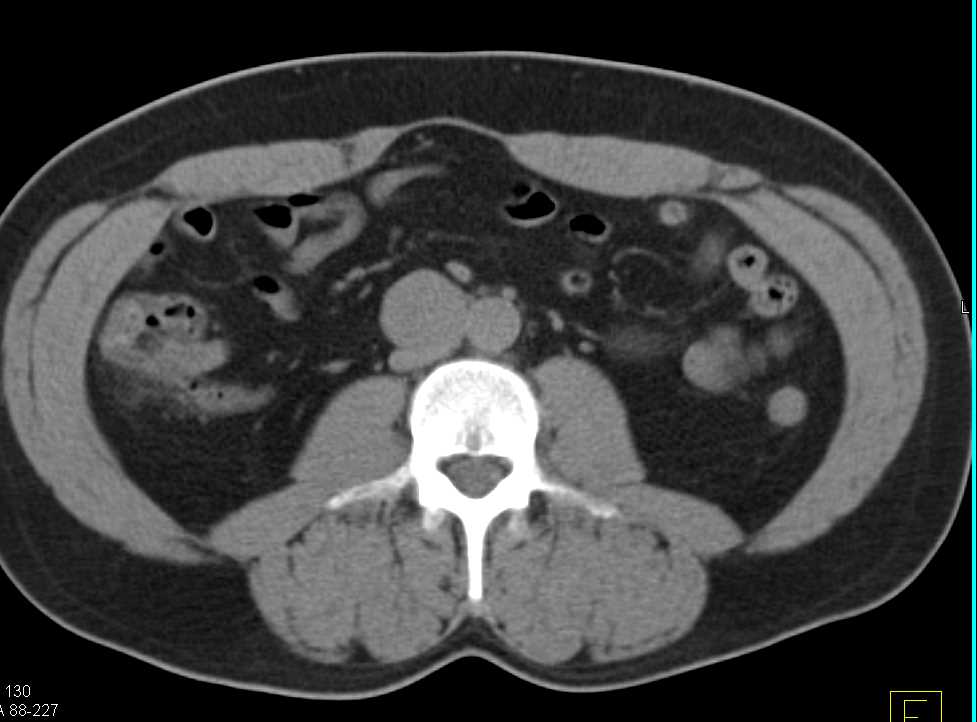 Enlarged Node Compresses Inferior Vena Cava (IVC) and Positive PET Scan - CTisus CT Scan