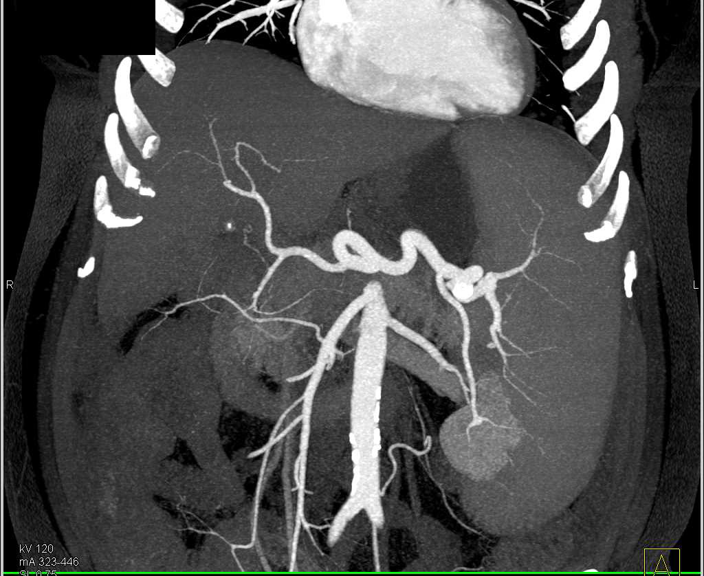 Rectal Cancer in a Patient with Cirrhosis and Portal Hypertension - CTisus CT Scan
