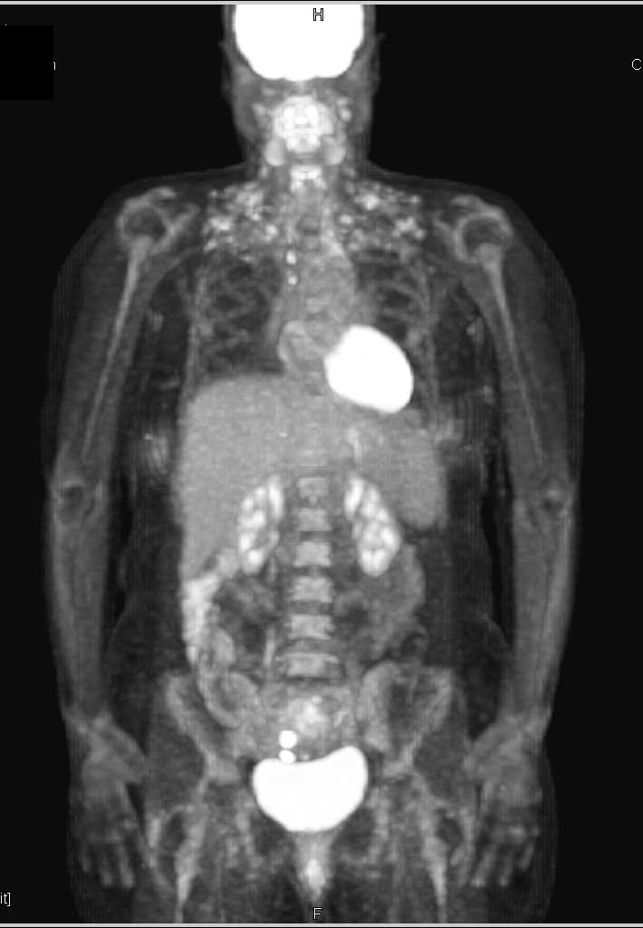 Subtle Breast Cancer with Multiple Nodules - CTisus CT Scan
