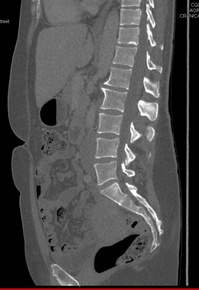 Metastatic Colon Cancer to Liver with Portal Adenopathy and Metastases to Sternum - CTisus CT Scan