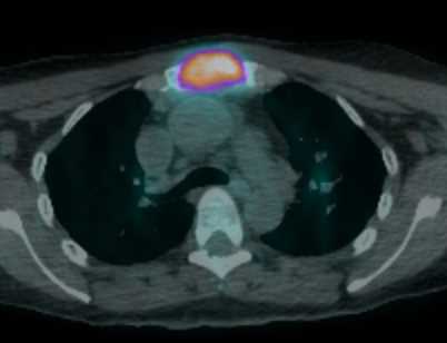 Metastatic Colon Cancer to Liver with Portal Adenopathy and Metastases to Sternum - CTisus CT Scan
