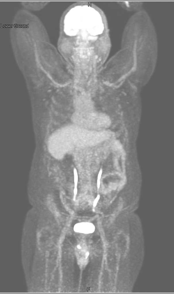 Transitional Cell Carcinoma Right Renal Pelvis - CTisus CT Scan