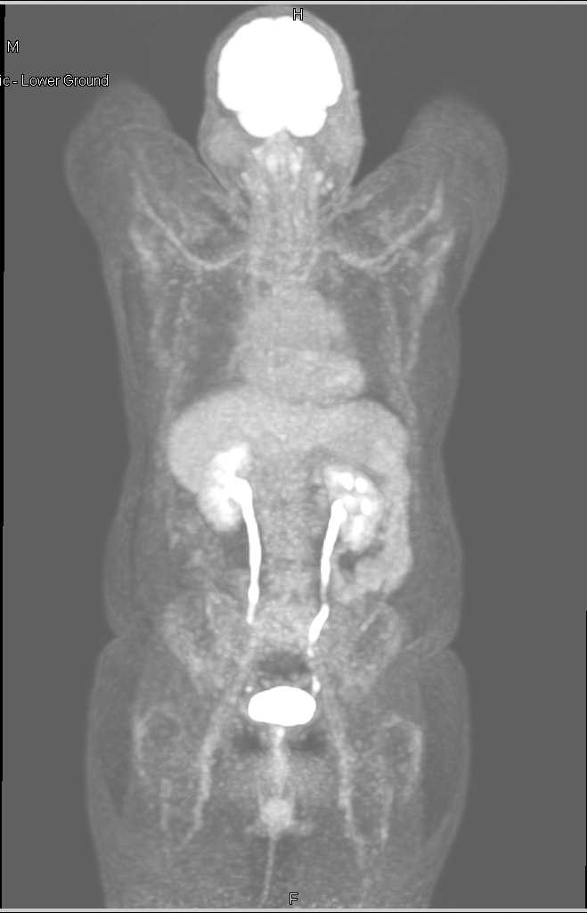 Transitional Cell Carcinoma Right Renal Pelvis - CTisus CT Scan