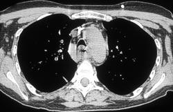 Esophageal Cancer - CTisus CT Scan