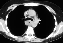 Esophageal Cancer - CTisus CT Scan