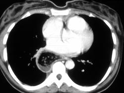 Achalasia - CTisus CT Scan