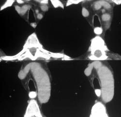 Leiomyoma Esophagus - CTisus CT Scan