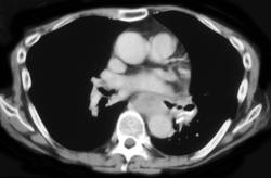 Esophageal Cancer With Celiac Nodes - CTisus CT Scan