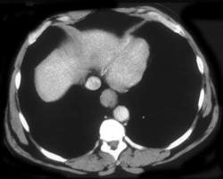 Esophageal Cancer With Adenopathy - CTisus CT Scan