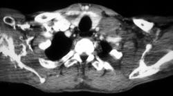 Dilated Esophagus - CTisus CT Scan