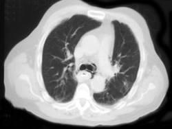 Perforated Esophagus Post Endoscopy - CTisus CT Scan