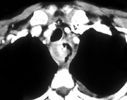 Esophageal Cancer With Perforation - CTisus CT Scan