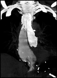 Esophageal Cancer With Leak - CTisus CT Scan