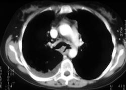 Te Fistulae - CTisus CT Scan