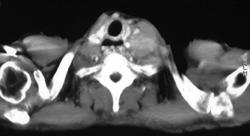 Supraclavicular Nodes Due to Esophageal Cancer - CTisus CT Scan