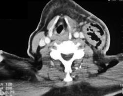 Perforated Esophagus - CTisus CT Scan